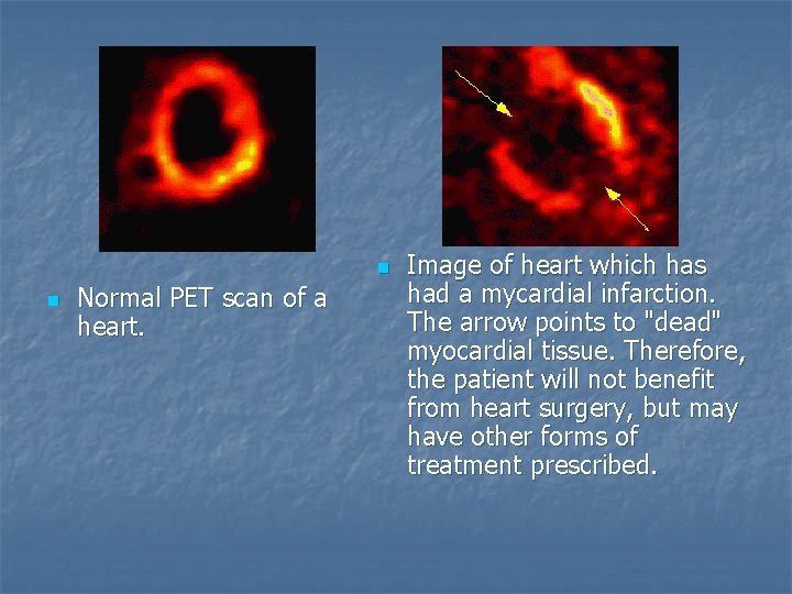 n n Normal PET scan of a heart. Image of heart which has had
