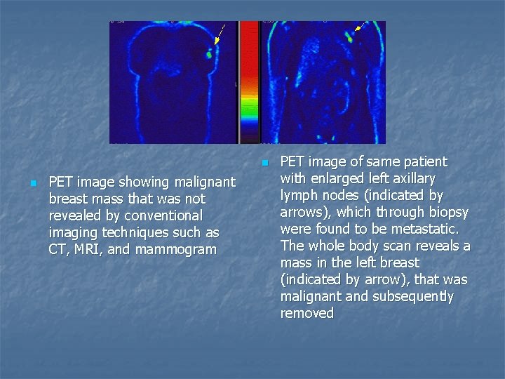 n n PET image showing malignant breast mass that was not revealed by conventional
