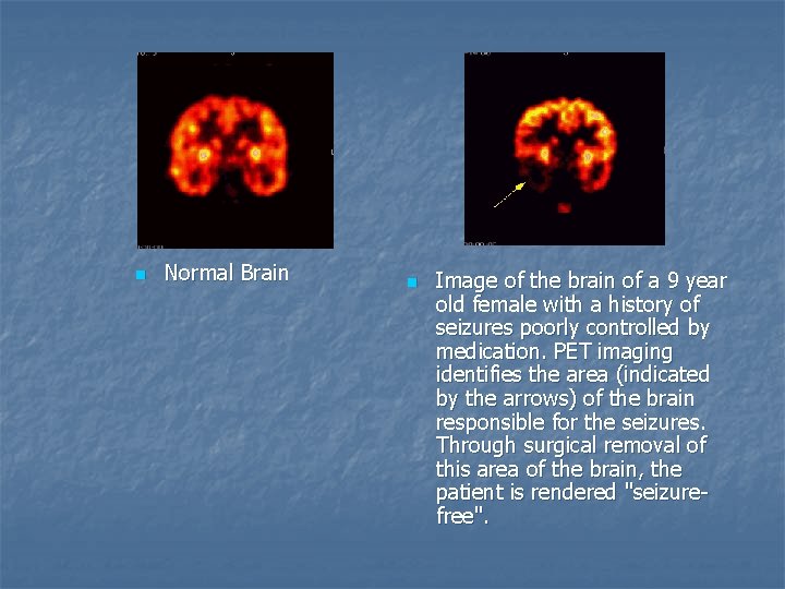 n Normal Brain n Image of the brain of a 9 year old female