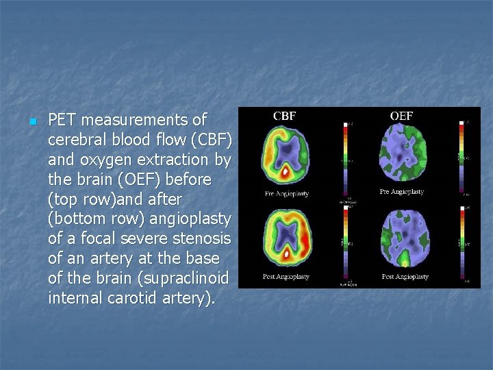 n PET measurements of cerebral blood flow (CBF) and oxygen extraction by the brain