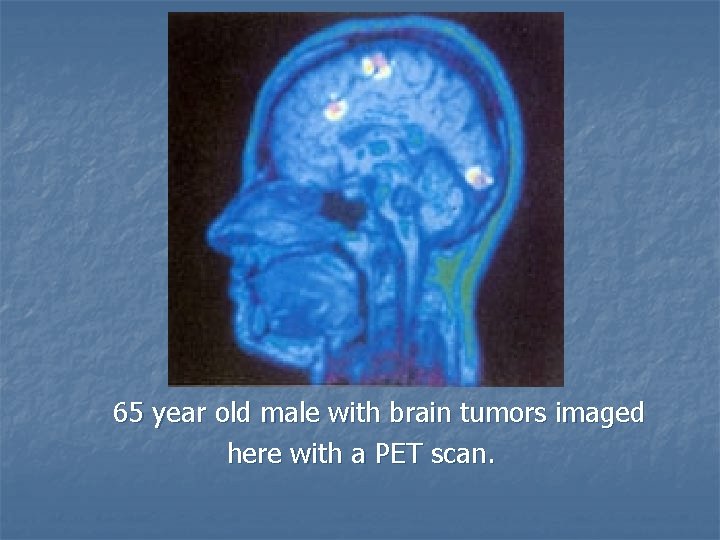 65 year old male with brain tumors imaged here with a PET scan. 