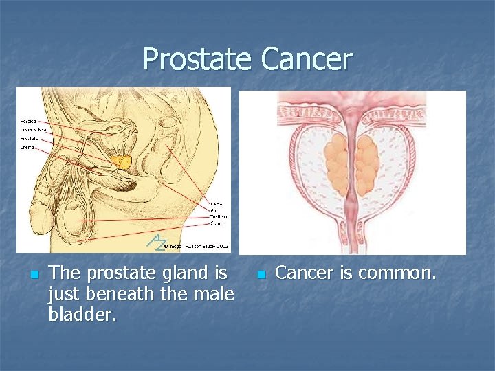 Prostate Cancer n The prostate gland is just beneath the male bladder. n Cancer