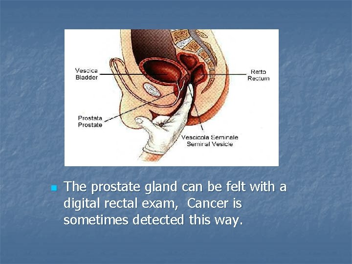 n The prostate gland can be felt with a digital rectal exam, Cancer is