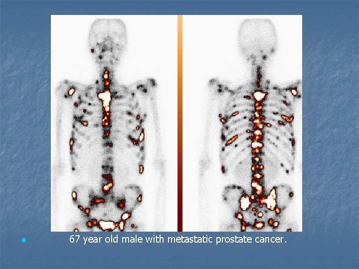 n 67 year old male with metastatic prostate cancer. 