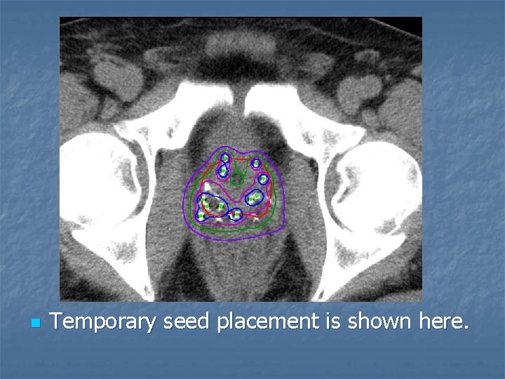 n Temporary seed placement is shown here. 