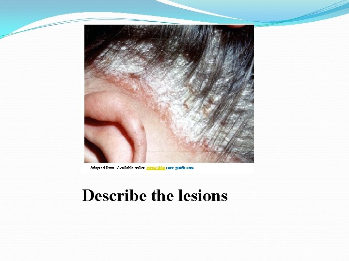 Adapted from: Available online www. skin care guide. com Describe the lesions 