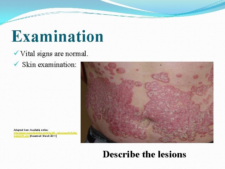 Examination ü Vital signs are normal. ü Skin examination: Adapted from: Available online: http: