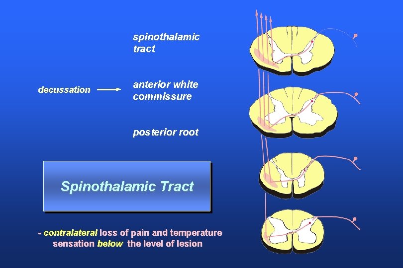 spinothalamic tract decussation anterior white commissure posterior root Spinothalamic Tract - contralateral loss of