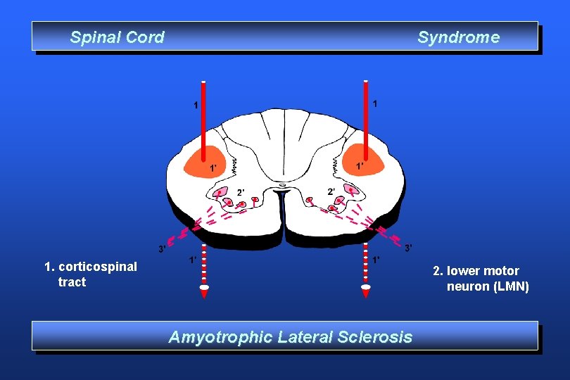 Spinal Cord Syndrome 1. corticospinal tract 2. lower motor neuron (LMN) Amyotrophic Lateral Sclerosis