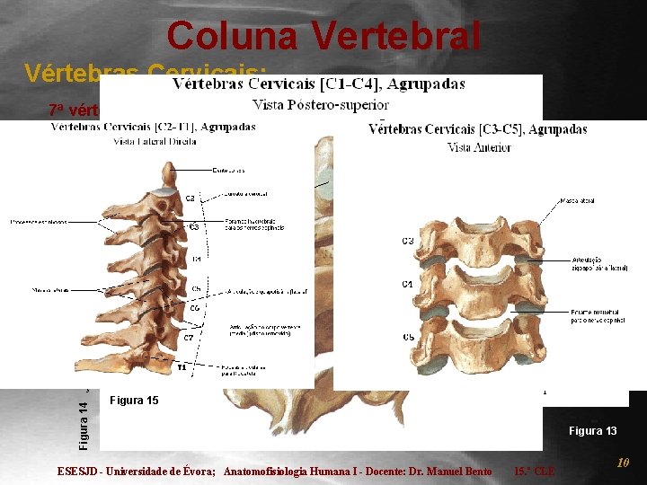 Coluna Vertebral Vértebras Cervicais: 7ª vértebra cervical (C 7) ou proeminente: - Vértebra de