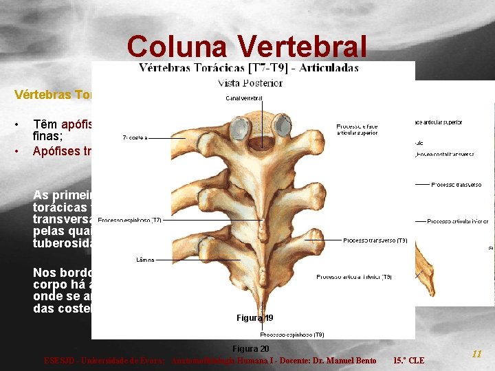 Coluna Vertebral Vértebras Torácicas (T): • • Têm apófises espinhosas longas e finas; Apófises