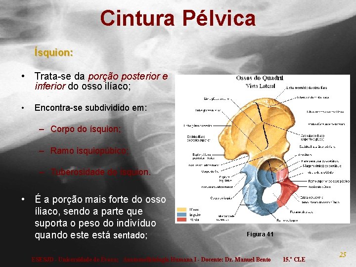 Cintura Pélvica Ísquion: • Trata-se da porção posterior e inferior do osso ilíaco; •