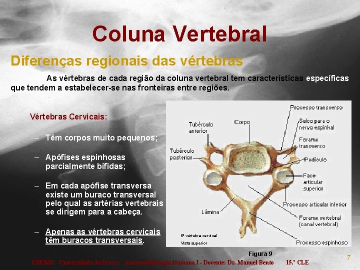 Coluna Vertebral Diferenças regionais das vértebras As vértebras de cada região da coluna vertebral