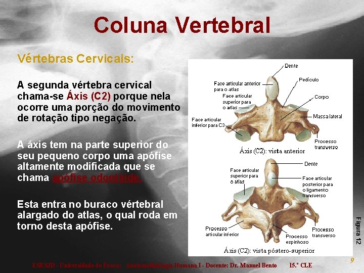 Coluna Vertebral Vértebras Cervicais: A segunda vértebra cervical chama-se Áxis (C 2) porque nela