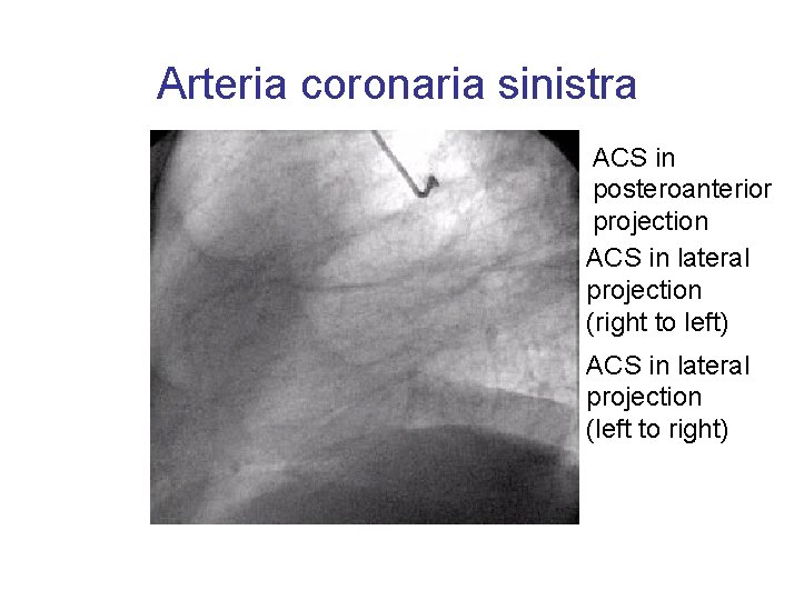 Arteria coronaria sinistra ACS in posteroanterior projection ACS in lateral projection (right to left)