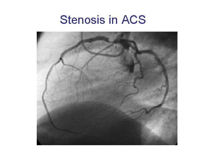 Stenosis in ACS 