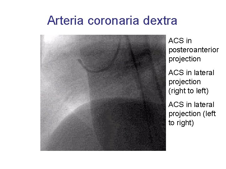 Arteria coronaria dextra ACS in posteroanterior projection ACS in lateral projection (right to left)