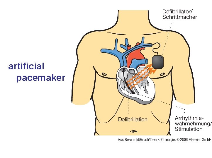artificial pacemaker 