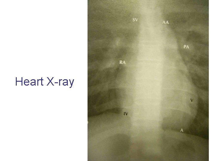 Heart X-ray 