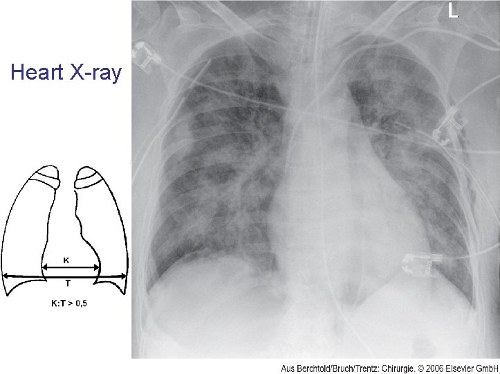 Heart X-ray 