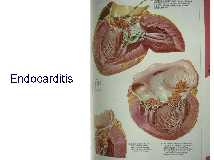 Endocarditis 
