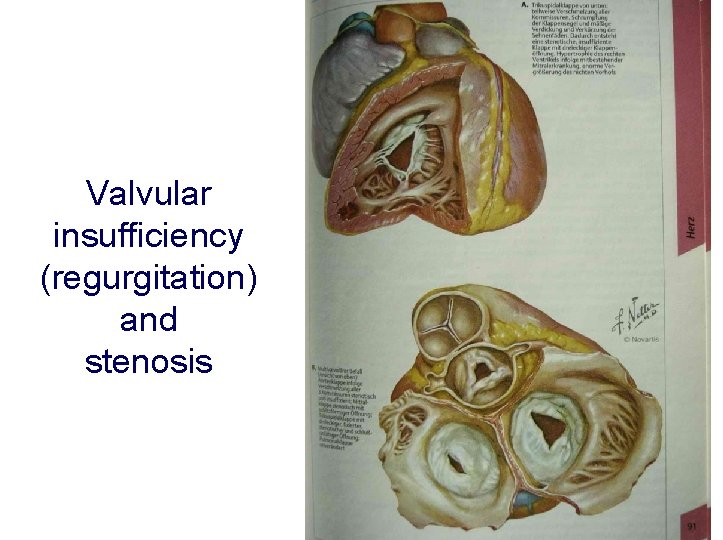Valvular insufficiency (regurgitation) and stenosis 