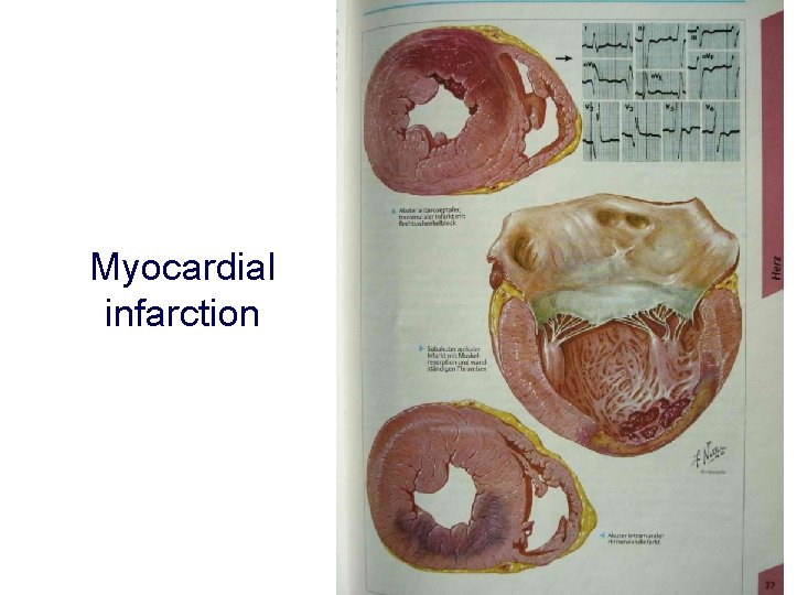 Myocardial infarction 