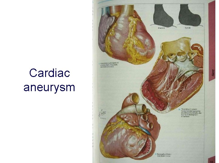 Cardiac aneurysm 