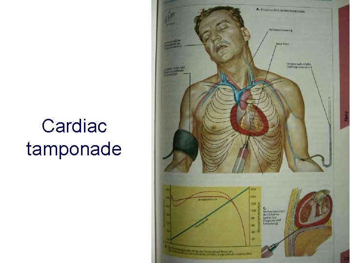 Cardiac tamponade 