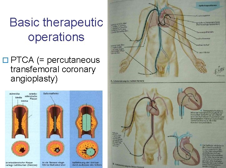 Basic therapeutic operations o PTCA (= percutaneous transfemoral coronary angioplasty) 