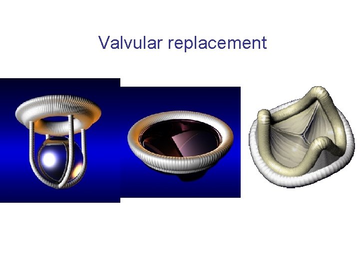 Valvular replacement 