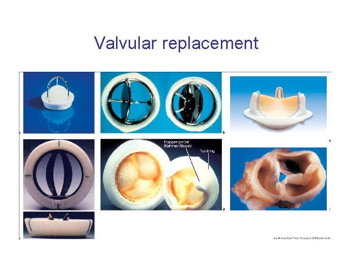 Valvular replacement 