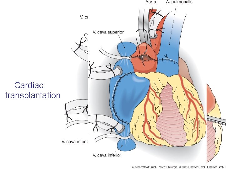 Cardiac transplantation 