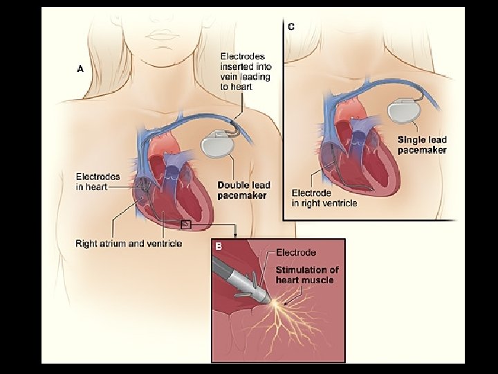 Pacemaker Cardiology for Dr Pelaez By Sai Kumar