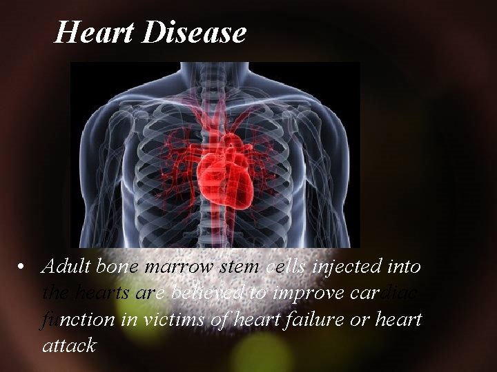 Heart Disease • Adult bone marrow stem cells injected into the hearts are believed