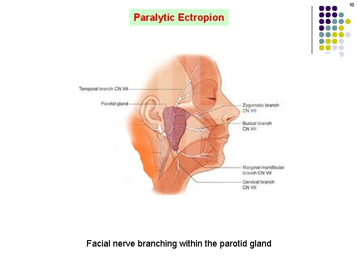 18 Paralytic Ectropion Facial nerve branching within the parotid gland 