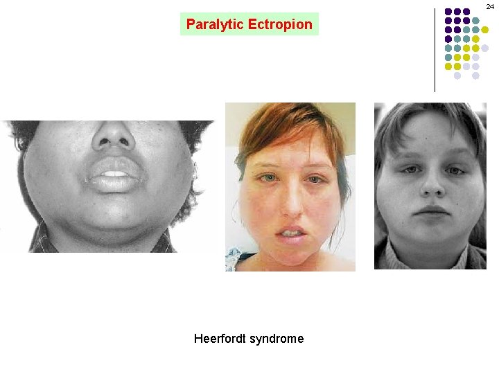24 Paralytic Ectropion Heerfordt syndrome 