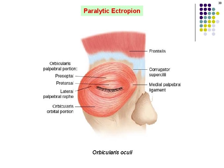 38 Paralytic Ectropion Orbicularis oculi 