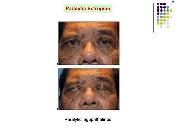 53 Paralytic Ectropion Paralytic lagophthalmos 