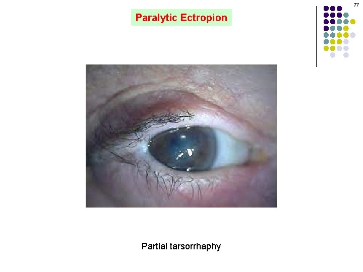 77 Paralytic Ectropion Partial tarsorrhaphy 