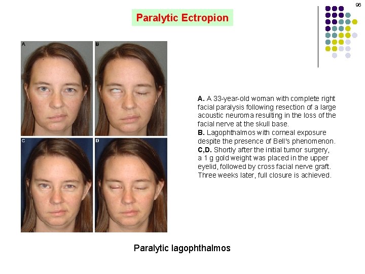 96 Paralytic Ectropion A. A 33 -year-old woman with complete right facial paralysis following