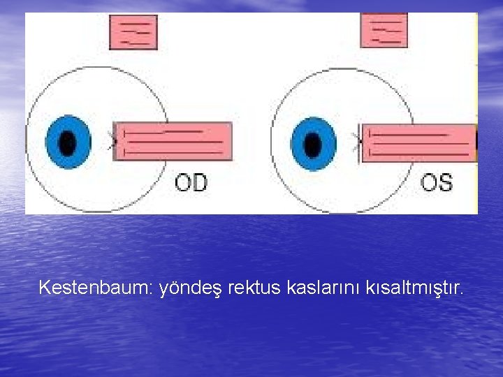 Kestenbaum: yöndeş rektus kaslarını kısaltmıştır. 