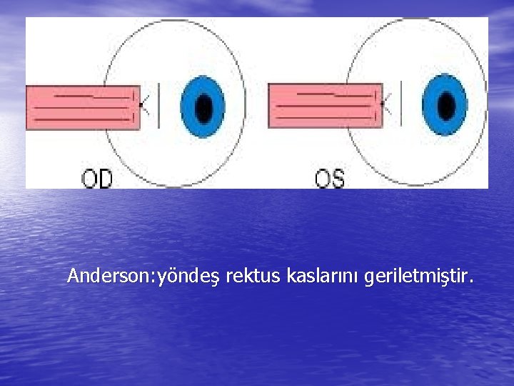 Anderson: yöndeş rektus kaslarını geriletmiştir. 