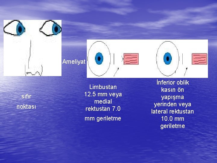 Ameliyat sıfır noktası Limbustan 12. 5 mm veya medial rektustan 7. 0 mm geriletme