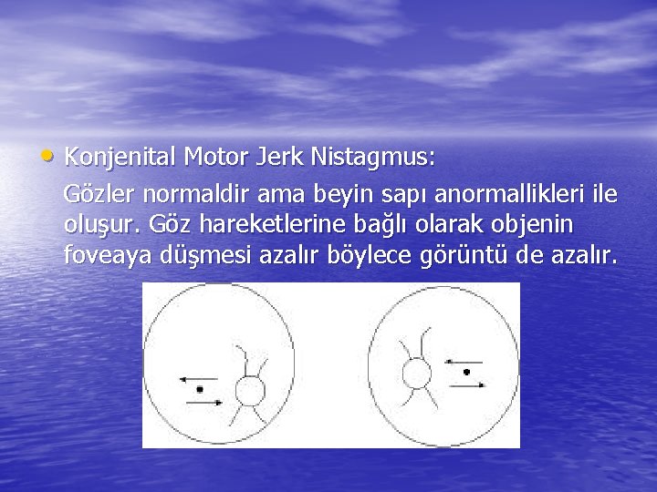  • Konjenital Motor Jerk Nistagmus: Gözler normaldir ama beyin sapı anormallikleri ile oluşur.