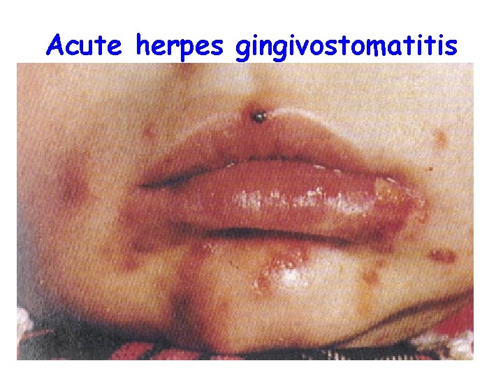 Acute herpes gingivostomatitis 