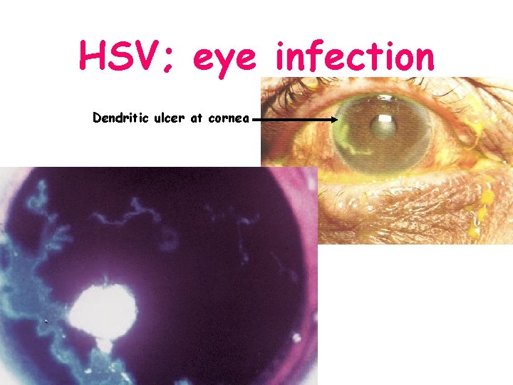 HSV; eye infection Dendritic ulcer at cornea 