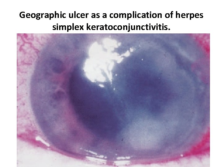 Geographic ulcer as a complication of herpes simplex keratoconjunctivitis. 