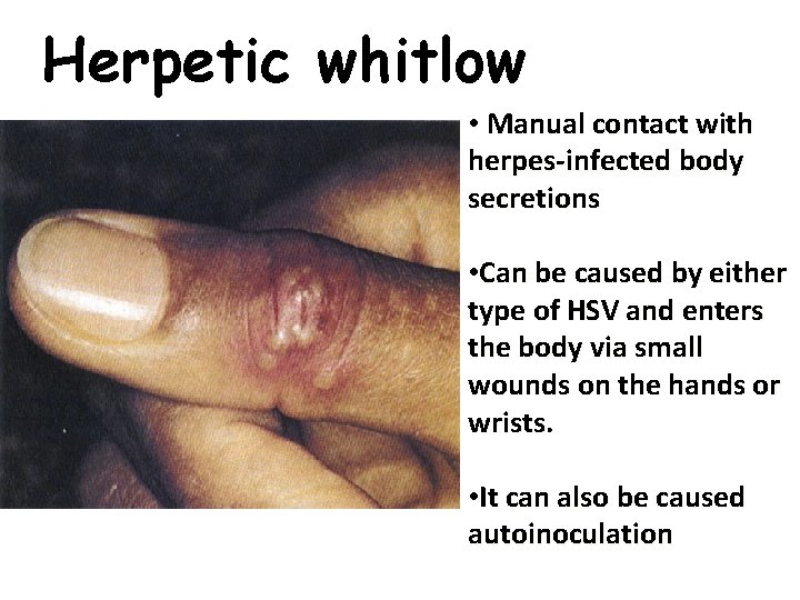 Herpetic whitlow • Manual contact with herpes-infected body secretions • Can be caused by