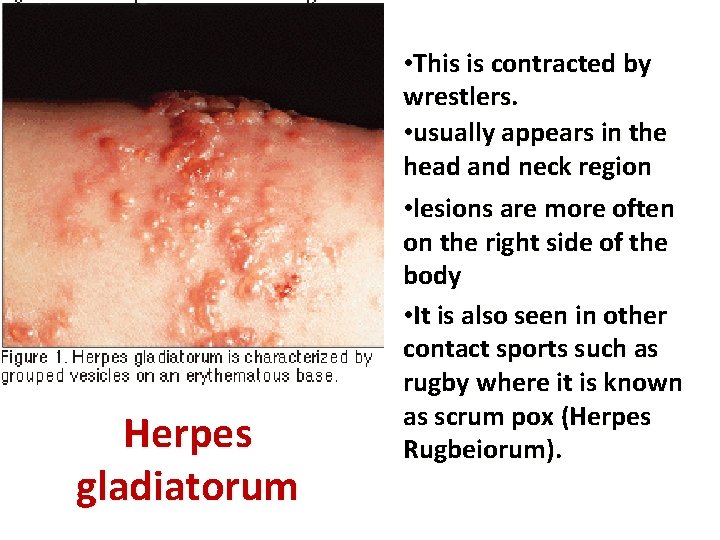 Herpes gladiatorum • This is contracted by wrestlers. • usually appears in the head